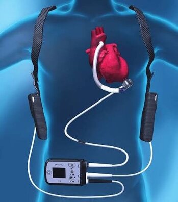 Schema_VAD-Versorgung_am_Patienten